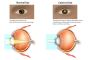 Is Cataracts and Glaucoma the Same?