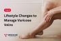 Revitalize Your Legs: The Top 5 Lifestyle Changes for Varico
