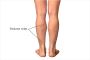 Are Varicose Veins Serious?