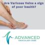 Are Varicose Veins A Sign Of Poor Health?