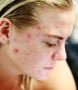 Get the Best Acne Treatment in Hyderabad