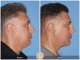 Discovering the Leading Neck Lift Surgeon in Newport Beach