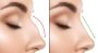 Rhinoplasty in Dubai, Abu Dhabi | Dr. Parag Telang Rhinoplasty in Dubai, Abu Dhabi | Dr. Parag Telang