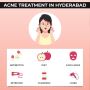 acne treatment in hyderabad
