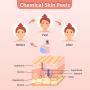 chemical peel treatment in Hyderabad