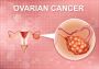 Advanced Ovarian Cancer Treatment in Ahmedabad