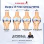 Stages of Knee Osteoarthritis