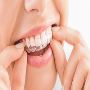 Straighter Smile With Invisalign Raleigh
