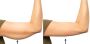 Arm Fat Reduction Treatment in Durgapur