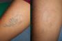 Tattoo Removal Treatment in Durgapur
