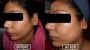 Acne Removal Treatment in Durgapur