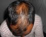 Male Hair Loss Treatment in Durgapur