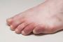 Homeopathy Medicine for Chilblains