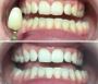 Teeth Whitening in Invercargill