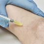 Varicose Veins Treatment in Maryland at Aestheticlavc