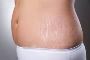 Stretch Mark Removal Treatment In Hyderabad