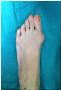5 Remedies for foot bunion surgery 