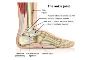6 Pain management therapy for ankle fracture surgery