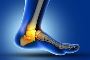 5 Condition to take ankle ligament surgery