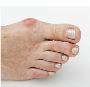 Bunion Removal Surgery 