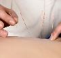 The Ultimate Guide to Acupuncture in Jacksonville, FL