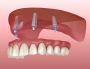 Get a Dental Implant Treatment in Banksia Grove