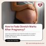 How to Fade Stretch Marks After Pregnancy? How to Fade Stretch Marks After Pregnancy?