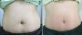 Safe & Effective Non-Surgical Belly Fat Removal Solutions