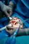 Broken Tooth Treatment in Australia