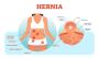 Hiatal Hernia Procedures