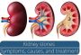 Kidney Stones - Symptoms, Types and Treatment
