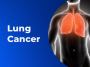 Lung Cancer Symptoms And Causes