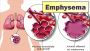 Emphysema - Symptoms And Causes