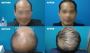 Amazing Results of Hair Regrowth Treatment Experts AU