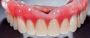 Get Perfectly Fitted Dentures in Bankstown