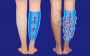 Experience the Best Varicose Veins Treatment with IRFaciliti