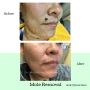 Here you can see This patient was treated for Mole