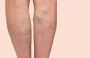 What Kind of Doctor Treats Varicose Veins?