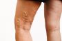 How Much Does Varicose Vein Treatment Cost?