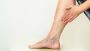 Are Varicose Vein Treatments Covered By Insurance?