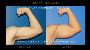 Enhance Your Arms with Bicep Implants for Men