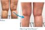 Leg Vein Rescue: A Natural Solution for Chronic Venous Insuf