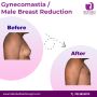 Gynecomastia Enlarged breasts in men