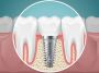 Dental Implants near me