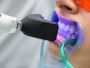 Teeth Cleaning Cost in Ahmedabad