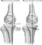 Best High Tibial Osteotomy Doctors | Knee Specialist In Jaip