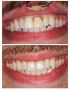 Single Front Tooth Crown Before And After