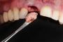 What Is A Dental Bone Graft?