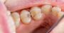 What Is The Difference Between Tooth Decay And Dental Caries