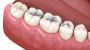 What Are Amalgam Or Silver Fillings?